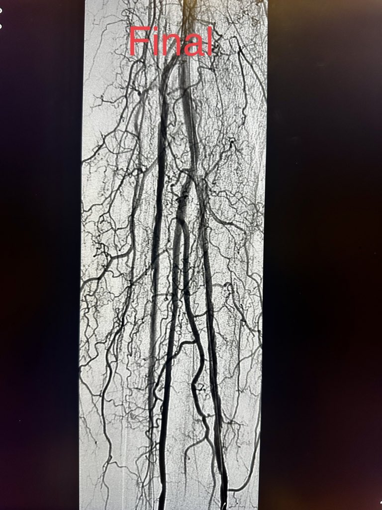 Ashish Gupta, MD, PhD (@dr_ashishg) on Twitter photo Patient in late 80s, non healing ulcers and ischemic pain in right leg. Complex multivessel tibial and pedal revascularization with #IVUS guidance, #Laseratherectomy and balloon angioplasty. Joys of limb salvage.<a href="/AMPSymposium/">AMP the CLTI Meeting</a> <a href="/CLI_Global/">CLI Global Society</a> <a href="/Vascupedia_com/">Vascupedia</a> Patient in late 80s, non healing ulcers and ischemic pain in right leg. Complex multivessel tibial and pedal revascularization with #IVUS guidance, #Laseratherectomy and balloon angioplasty. Joys of limb salvage.<a href="/AMPSymposium/">AMP the CLTI Meeting</a> <a href="/CLI_Global/">CLI Global Society</a> <a href="/Vascupedia_com/">Vascupedia</a>