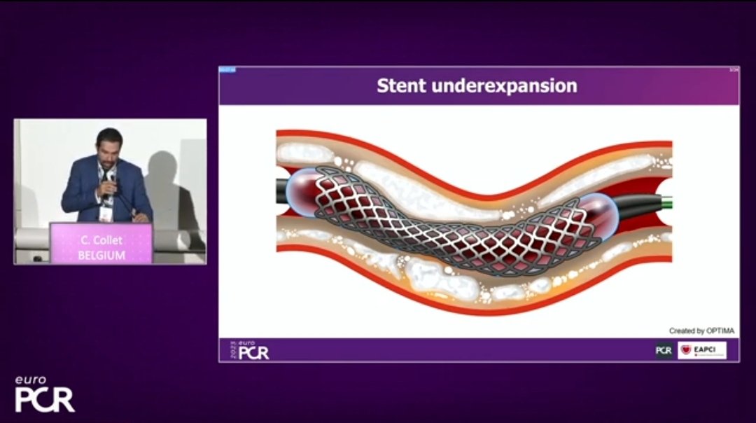 Zill_cardio's tweet photo. #EuroPCR 
#StentEnhancement

💥Stent Underexpansion and Value of 2D Stent Enhancement : Currently Available Angiographic and #IVImaging Options to Evaluate Stent Expansion 👇

@PCRonline #CardioTwitter https://t.co/s8uJEj6o72
