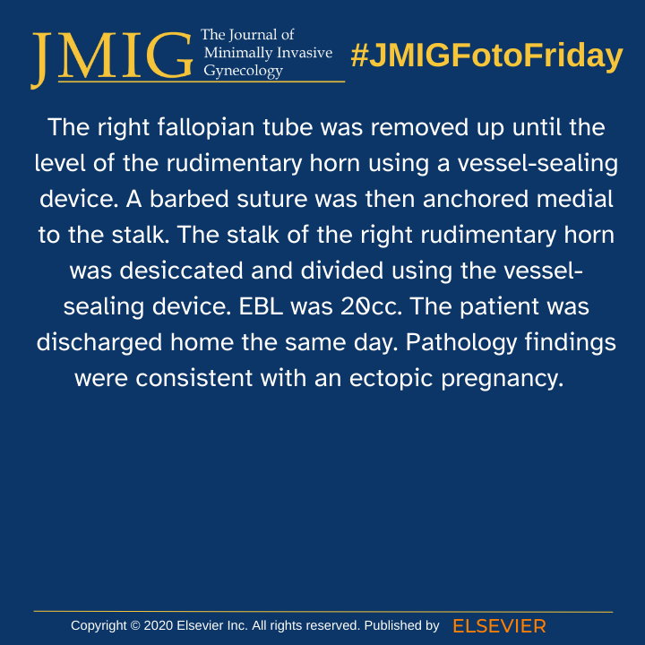 A case of successful laparoscopic management of an advanced nonruptured ectopic pregnancy in a rudimentary uterine horn.  

Read more⬇: doi.org/10.1016/j.jmig……
E Ekpe, MD, MPH  N Garg, MD, MS P Lui, MD J Sheran, MD A Chaudhari, MD  

#JMIGFotoFridays #MüllerianAnomalies