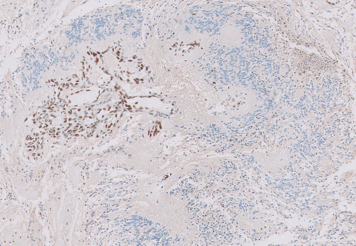 Posterior fossa Ependymoma, group A (PFA)

Notice the perivascular pseudorosettes, together with dot-like EMA positivity and loss of H3 K27me3 expression

These are aggressive ependymomas, common in young children

#PathTwitter #Neuropath