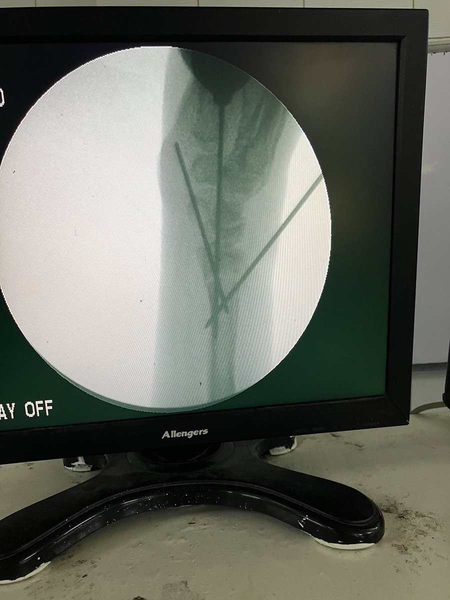 Kapandji intrafocal pinnining for extra articular distal radius fracture.