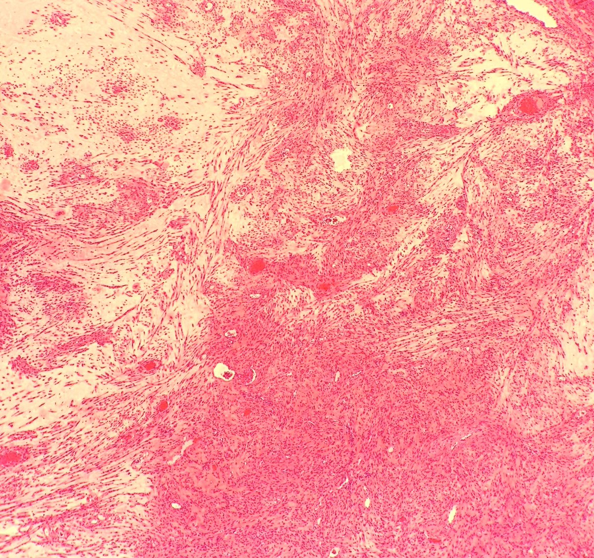 🟠Leiomyoma of the broad ligament🟠 ☑️ circumscribed, firm mass ☑️ may develop prominent hydropic and degenerative cystic change ☑️ similar patterns and changes to its uterine counterpart, including criteria for malignancy