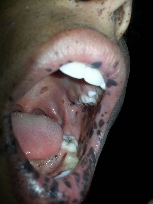 OperativeReview's tweet image. Continuing the trend, here are the most up-to-date recommendations in the understanding and management of Peutz-Jeghers Syndrome.

operativereview.com/peutz-jeghers-…

#MedEd #SoMe4Surgery #MedTwitter