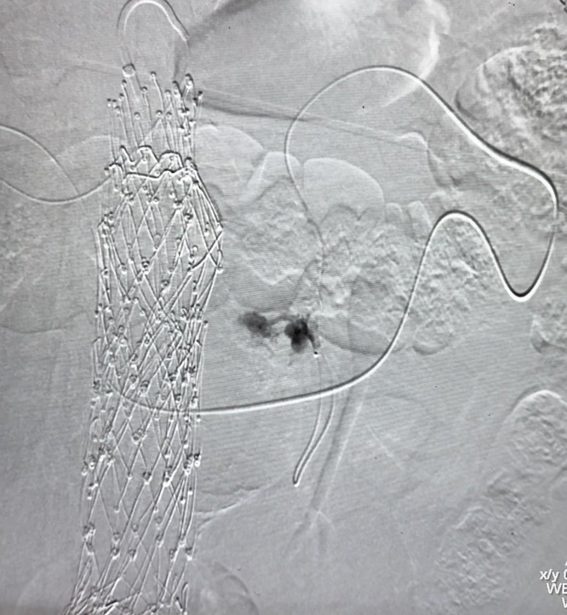 Adam Zybulewski, MD (@arzybule) on Twitter photo <a href="/SriniTummala/">Srini Tummala MD FSIR FSVM</a> <a href="/thegestgroup/">GEST -Global Embolization Symposium & Technologies</a> <a href="/SIRspecialists/">Society of Interventional Radiology</a> <a href="/CAIRweb/">Canadian Association for Interventional Radiology</a> <a href="/TraineesBSIR/">BSIR Trainees (British Society of IR Trainees)</a> <a href="/SIRRFS/">SIR RFS</a> <a href="/SIR_ECS/">SIR ECS</a> <a href="/VIVAPhysicians/">The VIVA Foundation</a> <a href="/ISETNews/">ISET</a> <a href="/ISEVSonline/">ISEVS</a> <a href="/BSIR_News/">The British Society of Interventional Radiology</a> <a href="/VascularSVS/">Society for Vascular Surgery</a> <a href="/ACCinTouch/">American College of Cardiology</a> <a href="/Balt_Group/">Balt</a> <a href="/KyleObradovich/">Kyle Obradovich</a> Is that <a href="/LindsayKThornt1/">Lindsay Karr Thornton</a> ‘s case from yesterday? Great result with <a href="/bostonsci/">Boston Scientific</a> TruSelect and <a href="/MDTVascular/">Medtronic Vascular Health</a> Onyx. Must be that <a href="/MountSinaiIR/">Mount Sinai IR</a> training. <a href="/SriniTummala/">Srini Tummala MD FSIR FSVM</a> <a href="/thegestgroup/">GEST -Global Embolization Symposium & Technologies</a> <a href="/SIRspecialists/">Society of Interventional Radiology</a> <a href="/CAIRweb/">Canadian Association for Interventional Radiology</a> <a href="/TraineesBSIR/">BSIR Trainees (British Society of IR Trainees)</a> <a href="/SIRRFS/">SIR RFS</a> <a href="/SIR_ECS/">SIR ECS</a> <a href="/VIVAPhysicians/">The VIVA Foundation</a> <a href="/ISETNews/">ISET</a> <a href="/ISEVSonline/">ISEVS</a> <a href="/BSIR_News/">The British Society of Interventional Radiology</a> <a href="/VascularSVS/">Society for Vascular Surgery</a> <a href="/ACCinTouch/">American College of Cardiology</a> <a href="/Balt_Group/">Balt</a> <a href="/KyleObradovich/">Kyle Obradovich</a> Is that <a href="/LindsayKThornt1/">Lindsay Karr Thornton</a> ‘s case from yesterday? Great result with <a href="/bostonsci/">Boston Scientific</a> TruSelect and <a href="/MDTVascular/">Medtronic Vascular Health</a> Onyx. Must be that <a href="/MountSinaiIR/">Mount Sinai IR</a> training.