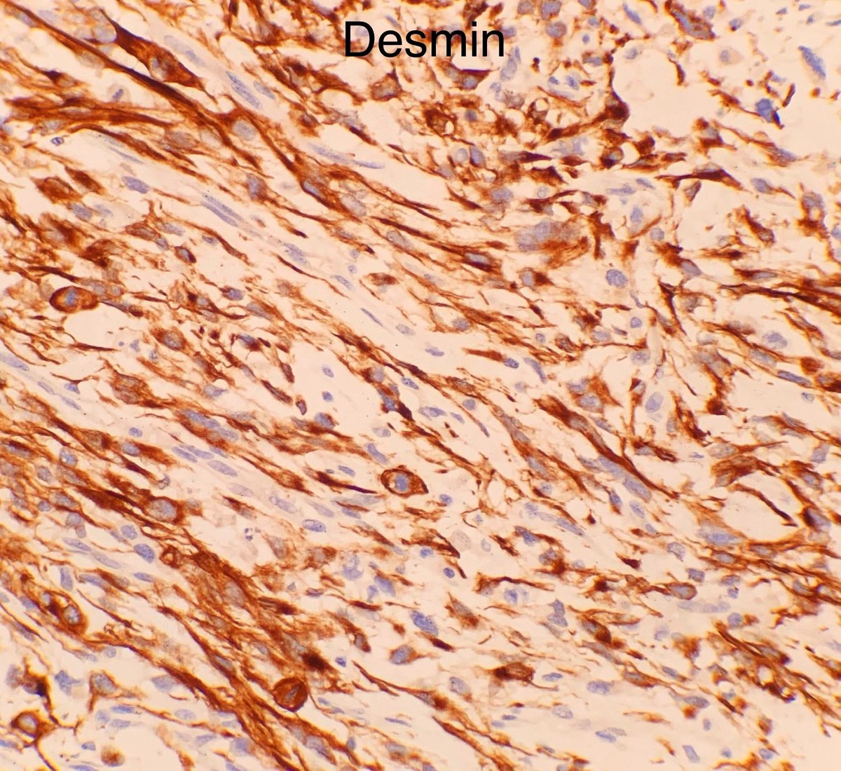 🟪 Uterine myxoid leiomyosarcoma🟪 ✅ abundant myxoid stroma ✅ vague fascicular or nodular growth Importantly, different criteria for malignancy compared to conventional (spindle cell) tumours. Sample well for presence of any: ✅ significant (2+ or 3+) ✅ tumour cell…