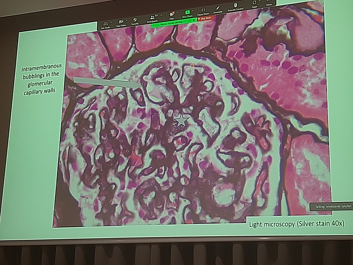 monik ediana (@monikediana) on Twitter photo The spike and bubbly case!,
thank you for sharing such interesting case
<a href="/cindymontero/">CYNTHIA MONTERO</a>
<a href="/kidneypathology/">Carmen Avila</a>
<a href="/ISNkidneycare/">Int Society of Nephrology</a>
#ThisIsISN The spike and bubbly case!,
thank you for sharing such interesting case
<a href="/cindymontero/">CYNTHIA MONTERO</a>
<a href="/kidneypathology/">Carmen Avila</a>
<a href="/ISNkidneycare/">Int Society of Nephrology</a>
#ThisIsISN