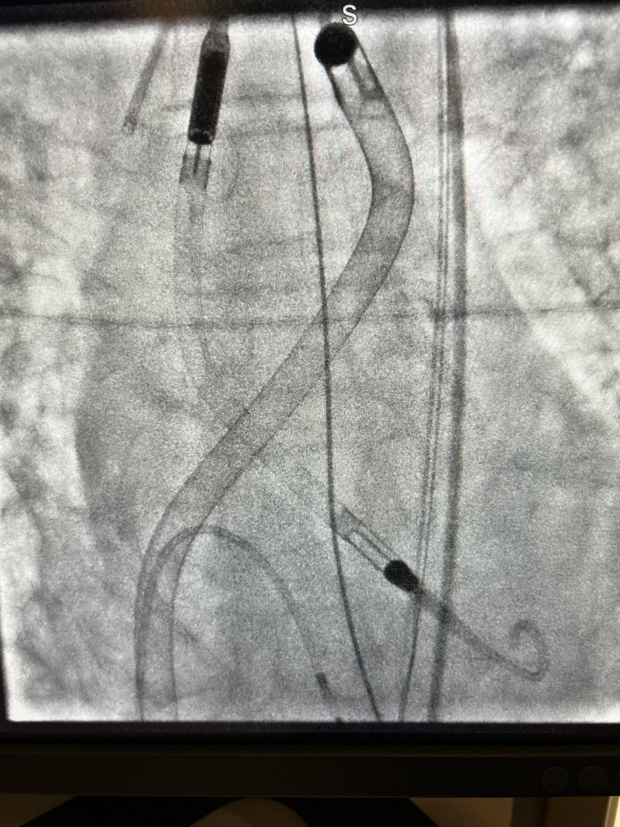 cardiowiis's tweet photo. Not exactly how I wanted to start this call weekend! #LMSTEMI #Bipella https://t.co/GUpIZlcMaj