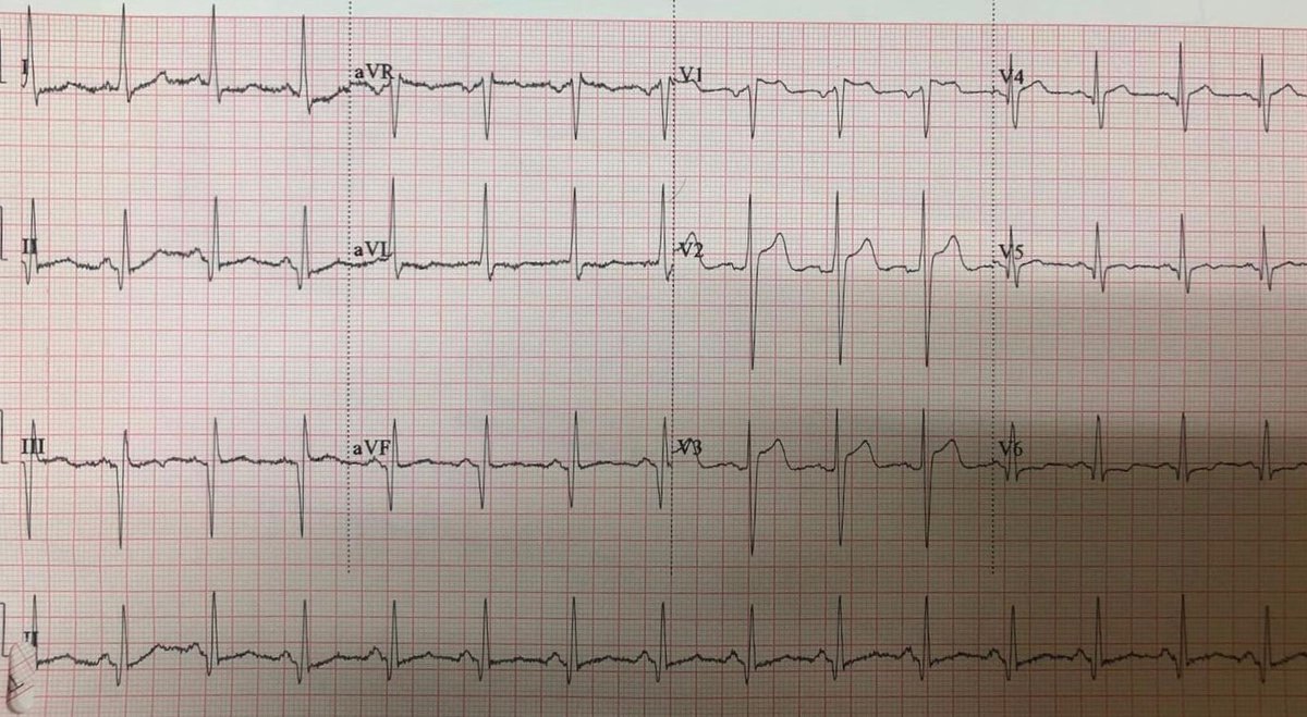 Chest pain 

Is this ECG diagnostic of OMI / STEMI?