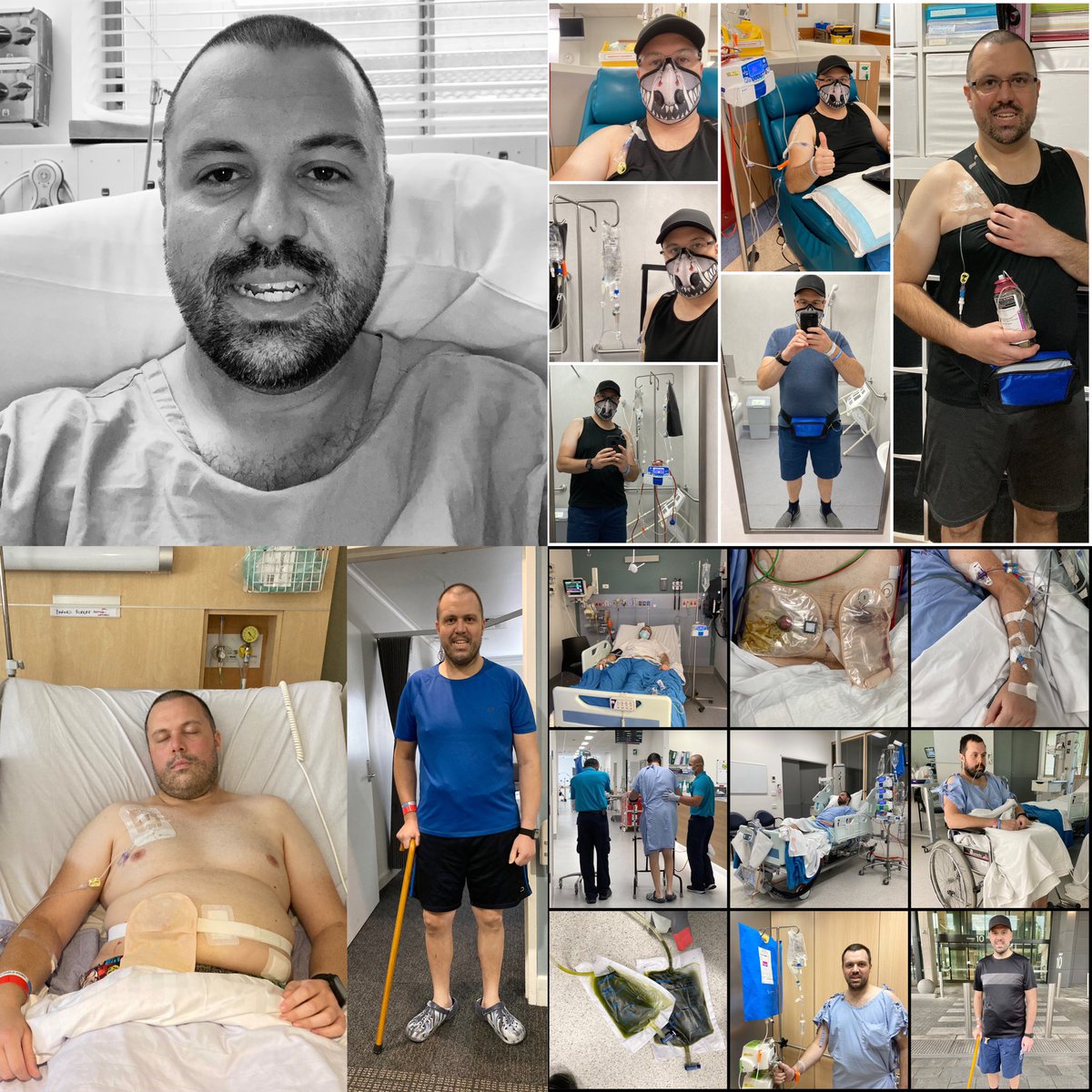 One year ago I was diagnosed with Stage 3 Bowel Cancer
#stoma #surgery #ostomy
#ileostomy #colostomy
#giveashitaboutyourbowel
#bowelcanceraustralia 
#chemoradiotherapy
#chemotherapy
#radiotherapy
#nevertooyoung 
#never2young 
#colorectalcancer
#bowelcancer 
#coloncancer 
#cancer