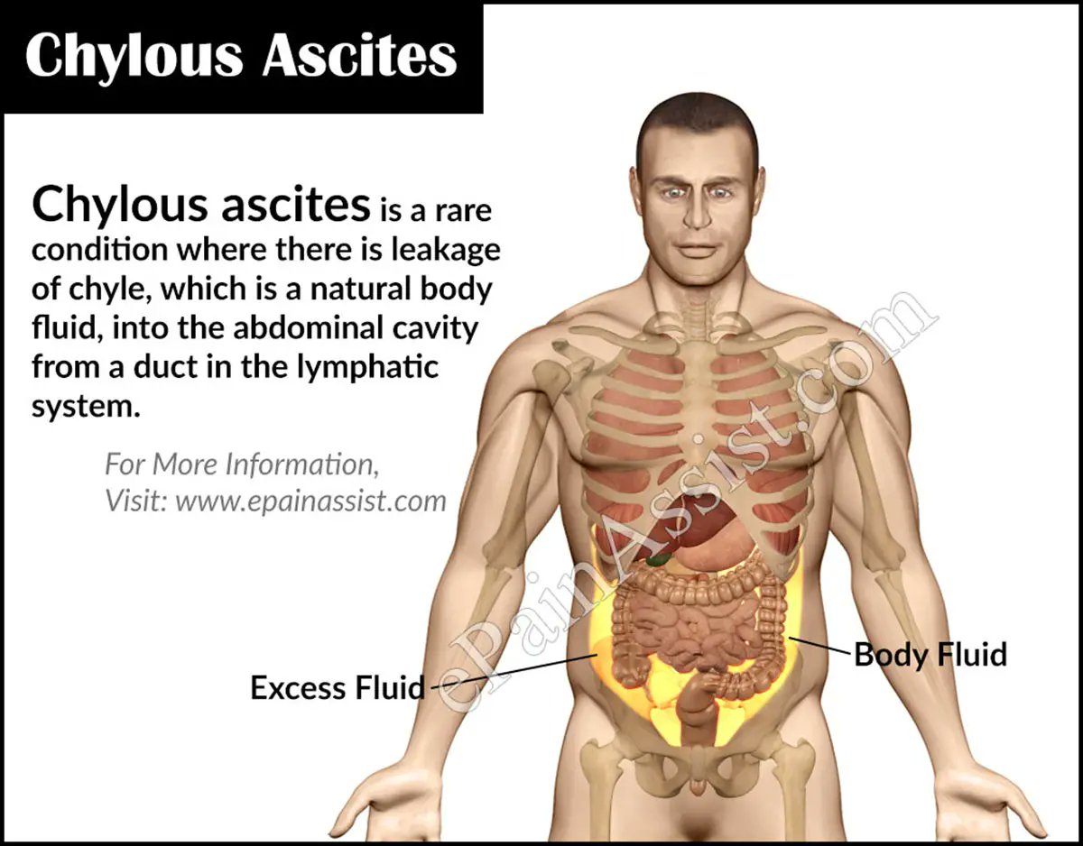 @drkeithsiau Chylous ascites is the extravasation of milky chyle rich in triglycerides into the peritoneal cavity, which can occur de novo as a result of trauma or obstruction of the lymphatic system