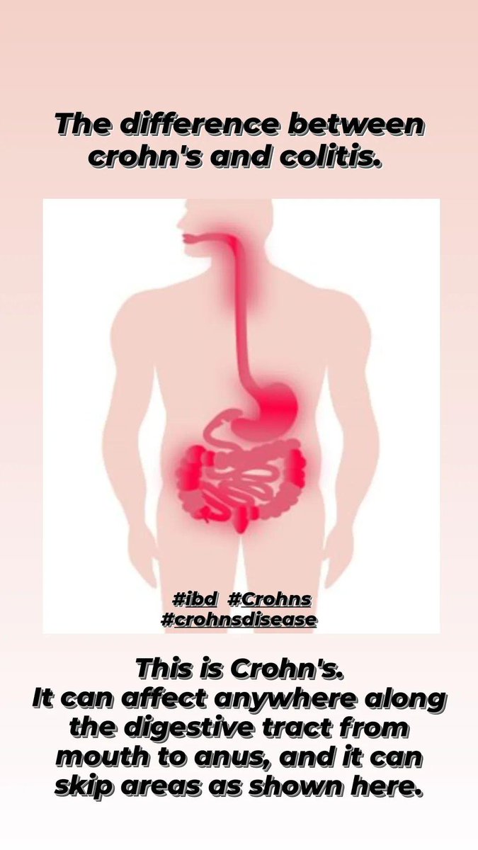 ThrivewithMilka's tweet photo. Do you know the difference between crohn's and colitis?
#ibd #ibdawareness #CrohnsDisease #colitis #ulcerativecolitis https://t.co/codKZCNHCX