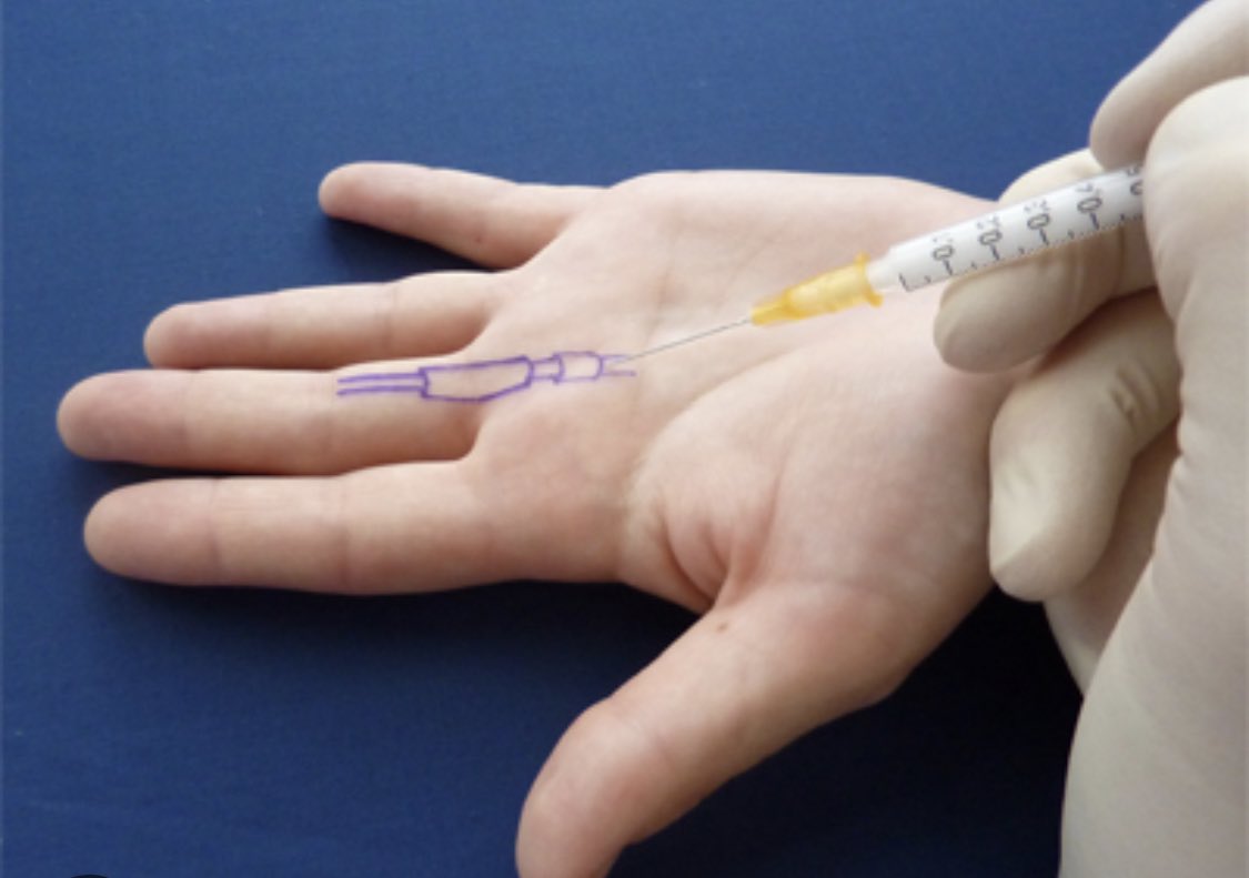nicklivadas's tweet photo. 💉Trigger Finger Injections 👋

Injectors…20mg Triamcinolone found to offer improved long term outcome 🤓

https://t.co/ZxQ6jnl6eI https://t.co/fKV8aCMyyG