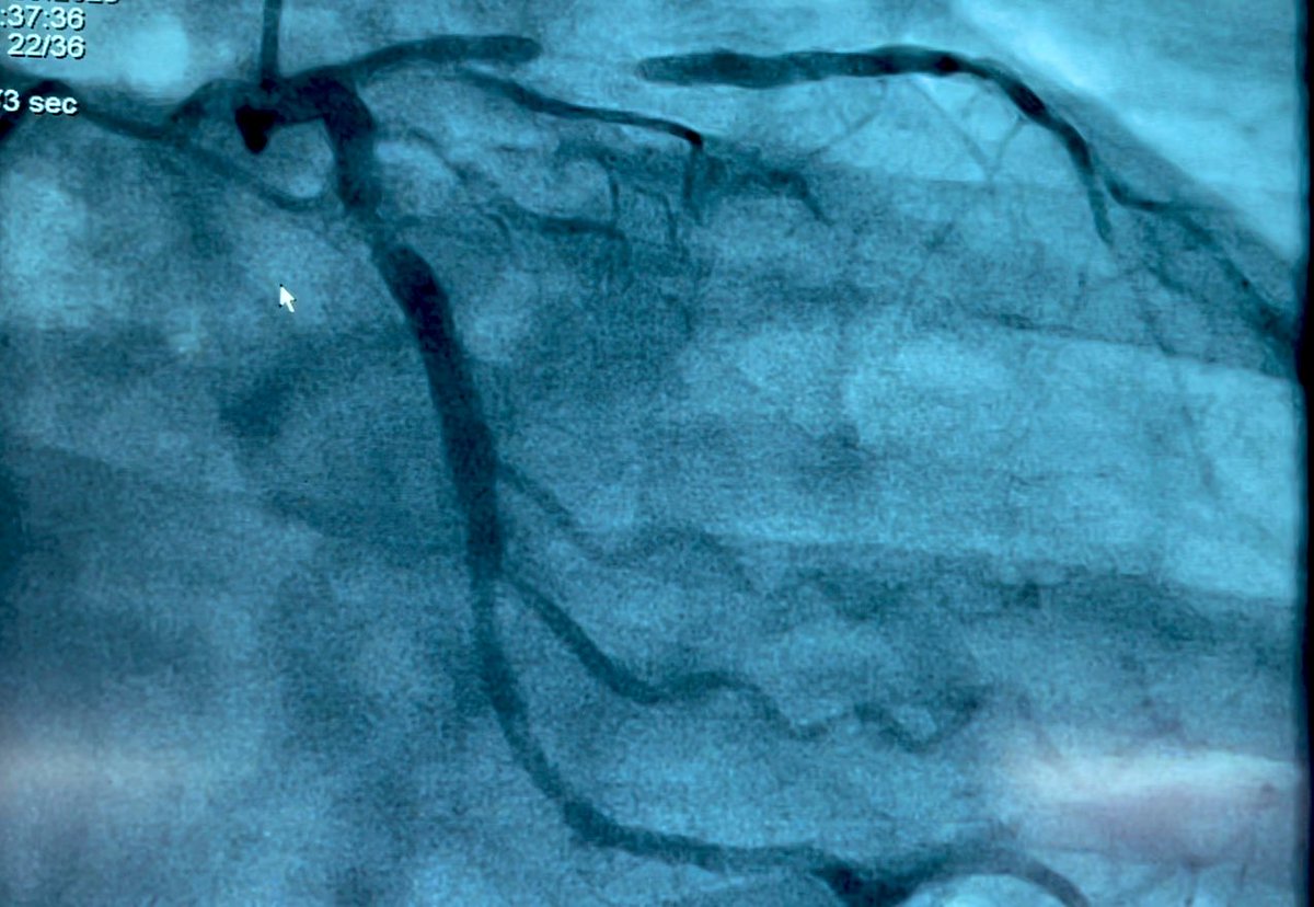 Magmaris Scaffold 3x15mm (Biotronic) bioabsorbable Scaffold implanted 2017, Pt. presented with ACS, IVUS shows undersized Stent with remaining Struts 6 years later
#AGIK #CardioTwitter #PCI #IVUS 
@Hragy @abadkhan2002 @esbrilakis @MuhametSinani @KardiologieHH @Obisht @DrRajeshG1