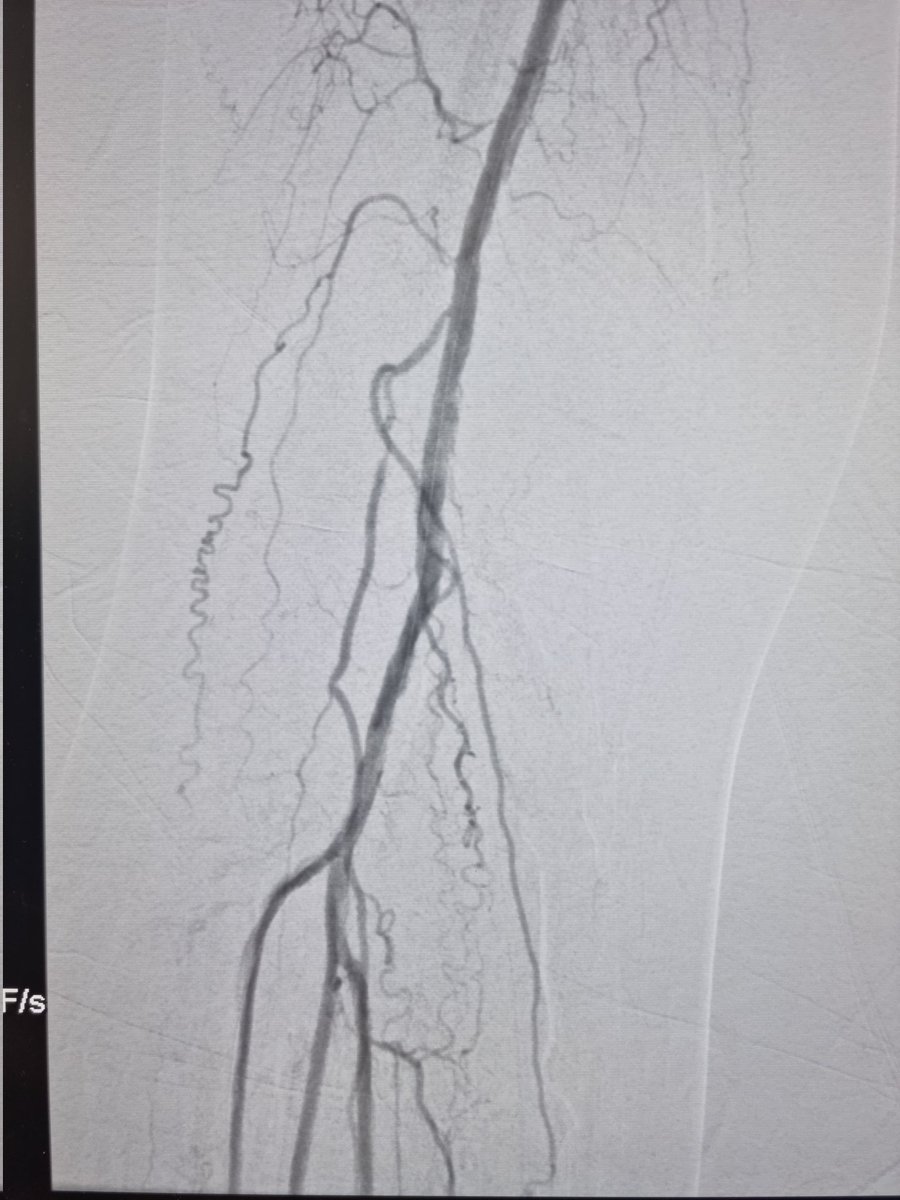 Saturday night sheninagans in cath lab. Recanlization of a occluded P2/P3 and trifurcation. Palpable DP and PT pulses post op! The feeling is priceless! #limbsalvage #IRad #PADed #CLTI #vascular #vascularsurgery