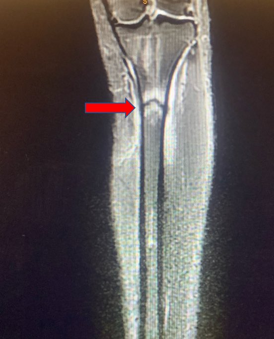 orthoEMpearls's tweet photo. All pain no gain.🏃‍♀️🏃🏃‍♂️💨

Follow along for more details on this case of a cross country runner. #FOAMed #sportsmedicine #amssm #SAEM23 

https://t.co/P5g3OKayR5 https://t.co/sfMtcmT7Ms