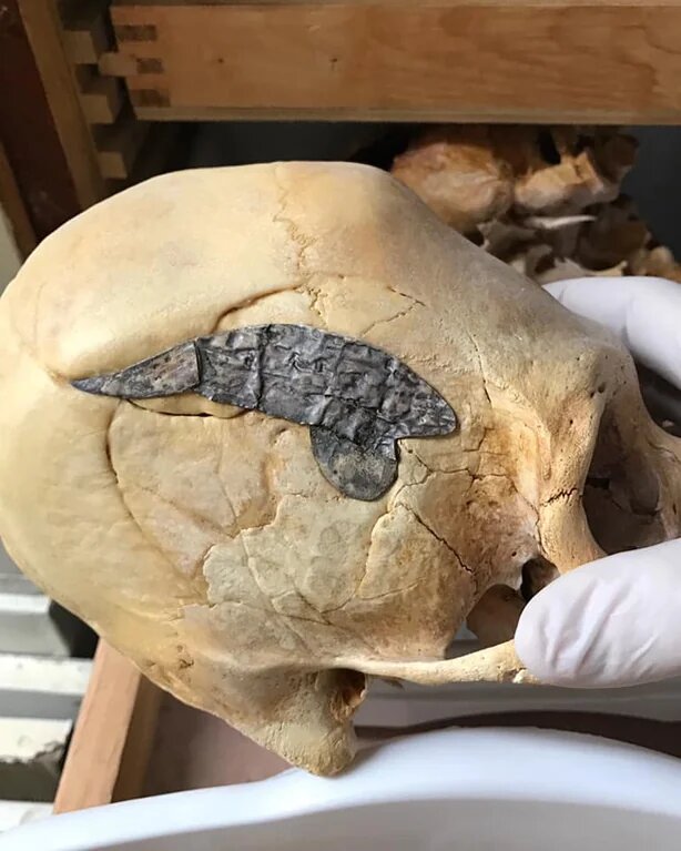 A Peruvian elongated skull with metal surgically implanted after returning from battle, estimated to be from about 2000 years ago. The broken bone surrounding the repair is tightly fused together indicating it was a successful surgery.