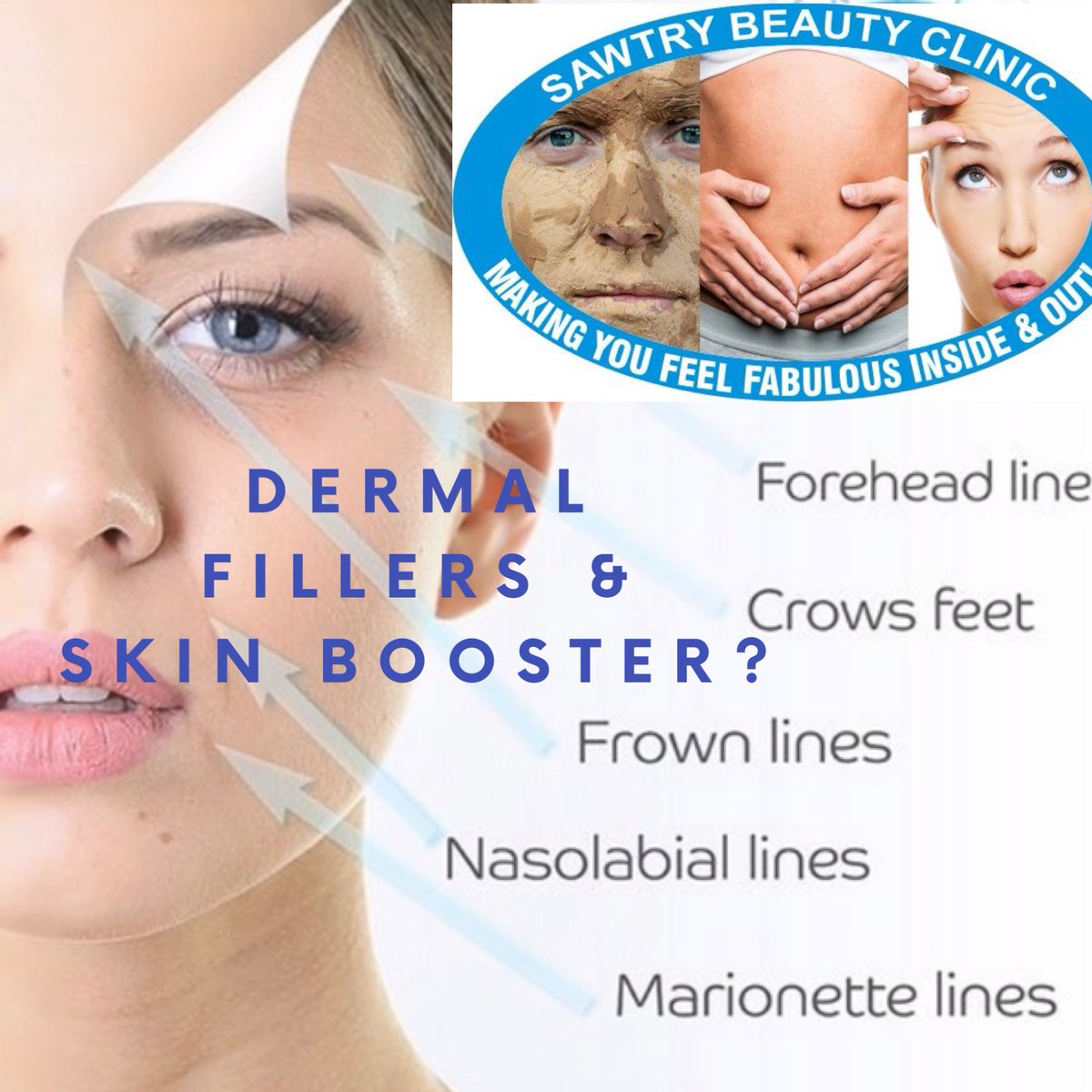 #Skinboosters improve hydration levels in the dermis reduce pore size, smooth out wrinkles & fine lines, lighten age spots gives youthful skin improved elasticity! #dermalfillers help to diminish facial lines & restore volume ,fullness in the face
#sawtry
#sawtrybeautyclinic