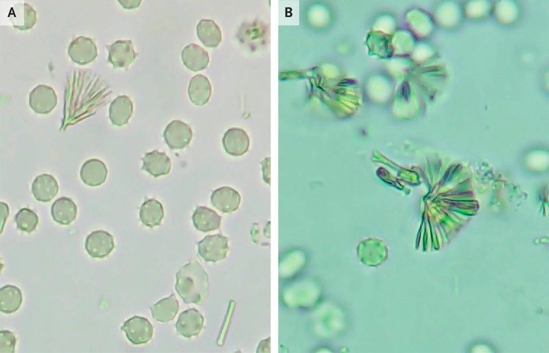 🔥Utility of urine microscopy in AKI 
📌A pt of PLHA with PCP pneumonia on therapy (Septran) presented 1 week later with oliguric AKI ( Creat 3.7) 
⭐️Urinalysis- WBC 5-10/hpf 
💡Urine M/E-fan shaped crystals with shock of wheat appearance 
🔥Dg - Sulfonamide crystal induced AKI