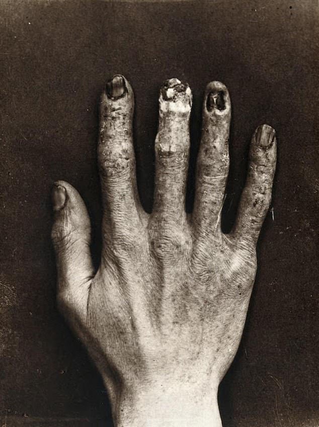 Hand of an X-ray Technician at the Royal London Hospital in the 1900s.

Physicist Wilhelm Conrad Röntgen unveiled one of the most significant breakthroughs in medical history with the discovery of X-rays. While experimenting with cathode light's ability to penetrate glass,…