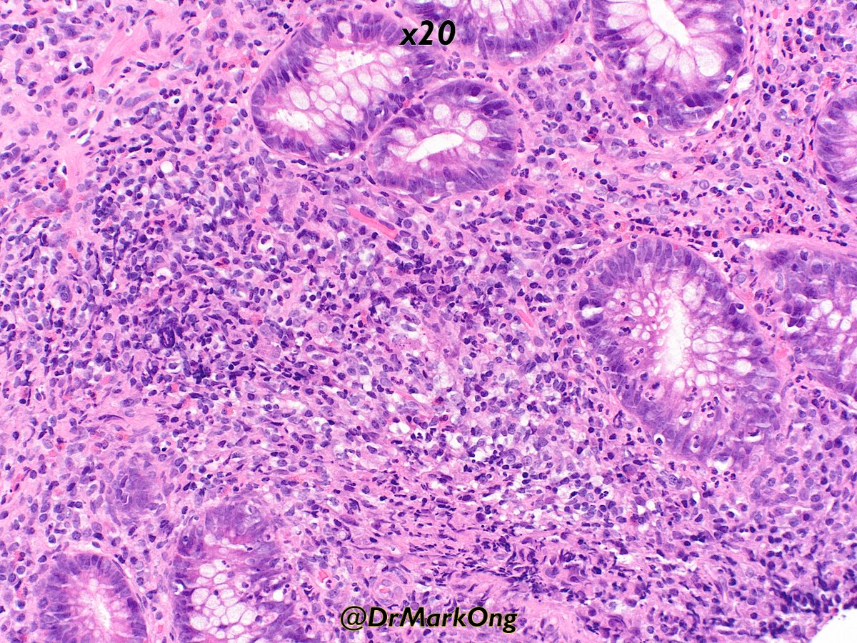 Colonic biopsies from patient diagnosed with ulcerative colitis. Granuloma associated with crypt rupture, sometimes called 'cryptolytic granulomata'. Usually confined to the mucosa and associated with crypt destruction. #GIpath #pathtwitter