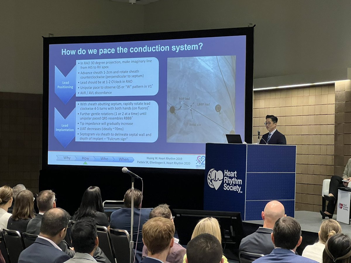 Sharing about conduction system pacing (CSP) or cardiac physiologic pacing (CPP)- new guidelines released today at #HRS23 for children and #ACHD by @JeffKimMD - option vs biv, narrows qrs, various HF criteria. @PACESep @TCHheartcenter @TCH_adultCHD
