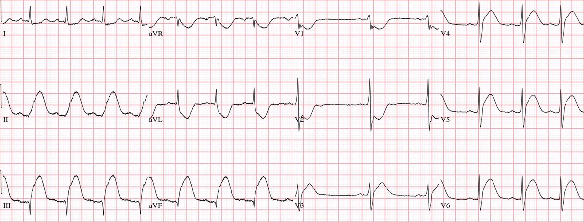 Farmers be like: “I’m fine Doc, it’s nothing, my wife made me come in.”

Their ECG: