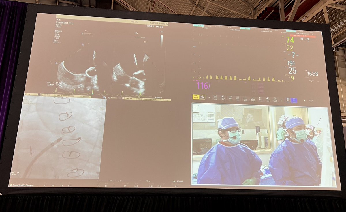 Great live case #HRS2023 from @OhioHealth using 3D ICE to guide LAAO implant @AnishAminEP @badinmd @caresans26 @StevenYakubov @SreeBillakanty #EPeeps @DrBradleyKnight