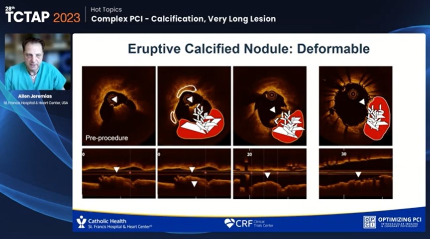 Zill_cardio's tweet photo. 💥#CN: Heterogenous response to stent expansion with ⬆️TLF overall wether #Eruptive or #Protruding https://t.co/pXKCMGxcFI