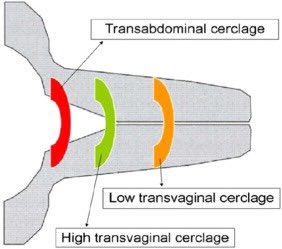 After TAC, most women achieve a healthy baby, even after multiple early losses with a vaginal stitch. We show the cervix stays long & closed compared to vaginal stitch. Does placement at the internal os keep structural integrity & explain the mechanism? doi.org/10.1016/j.ajog…