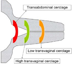 After TAC, most women achieve a healthy baby, even after multiple early losses with a vaginal stitch.  We show the cervix stays long &amp; closed compared to vaginal stitch. Does placement at the internal os keep structural integrity &amp; explain the mechanism? doi.org/10.1016/j.ajog…