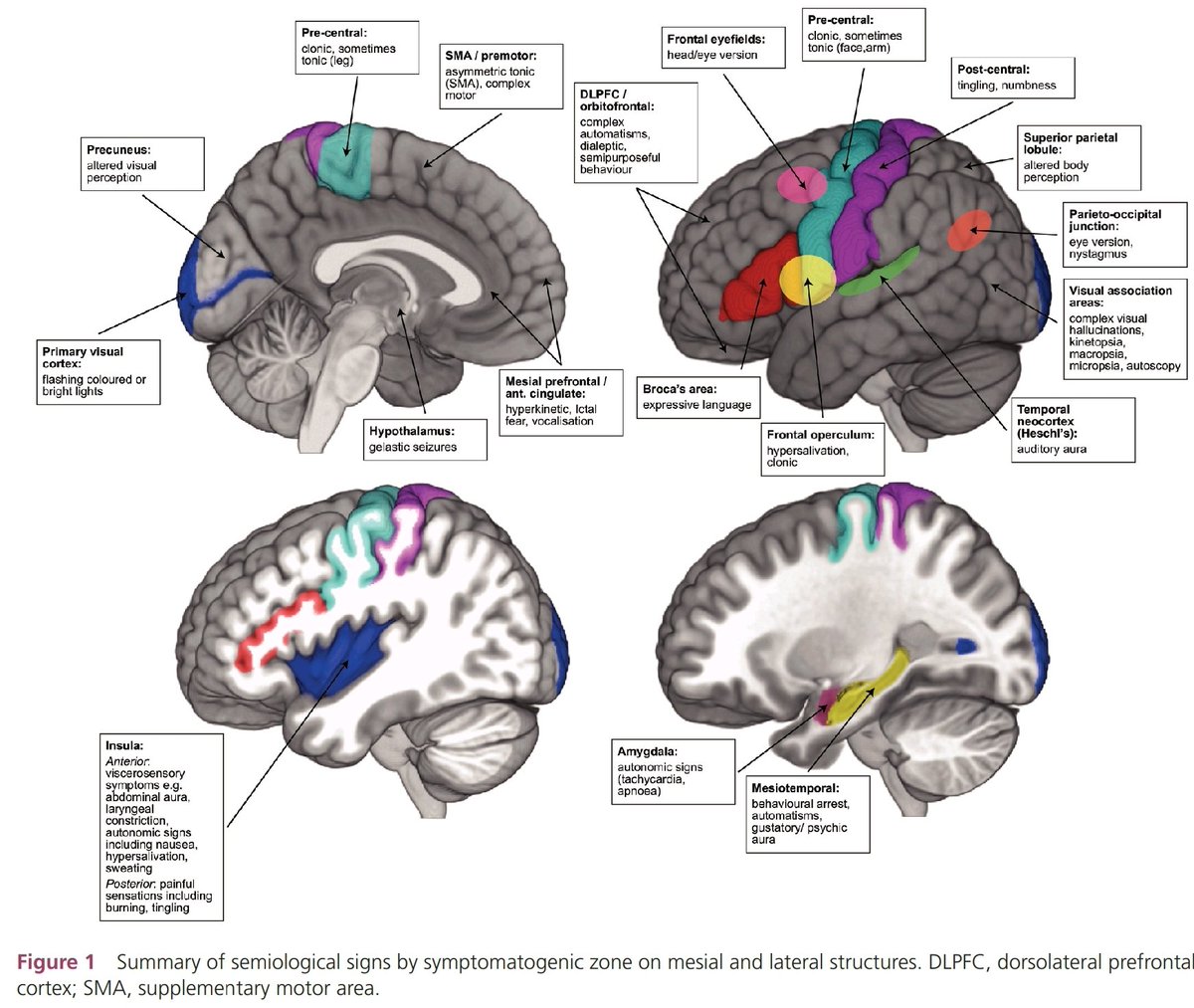 What a lovely summary of semiological signs by symptomatic zone !!
Chowdhury FA, et al. Pract Neurol 2021