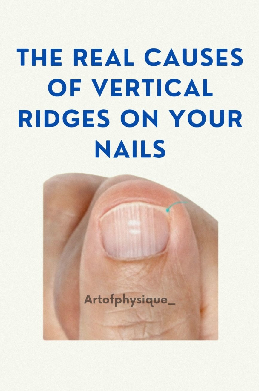Ridges in Nails: Meaning Behind Onychorrhexis