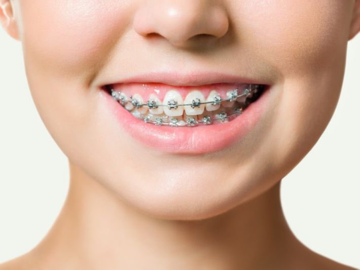 هل يعتبر تقويم الأسنان علاجا أم تجميلا؟