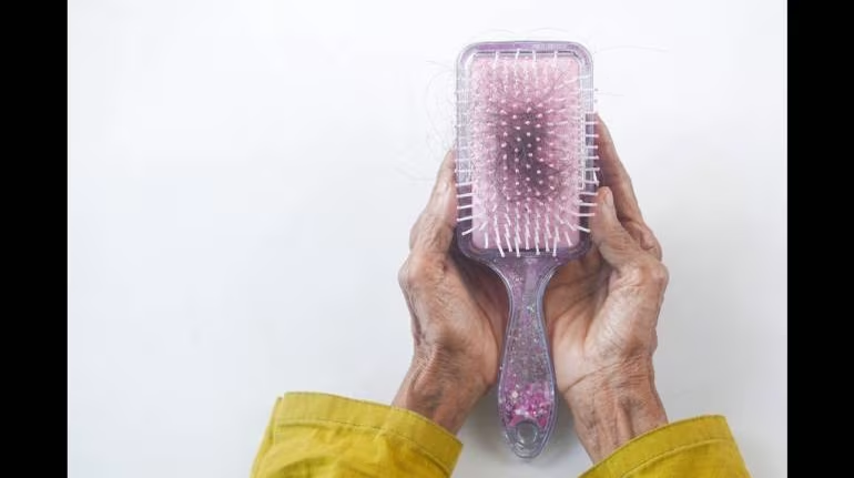 #MCWeekendReads⚡ #HairLoss When losing your hair makes you lose your mind. If you are under 40, and have been big on #biotin for long spells, time to pump up the vitamins + minerals to kick in that cellular turnover &amp; metabolic activity, writes <a href="/ShilpiMadan/">Shilpi Madan</a> 👇
