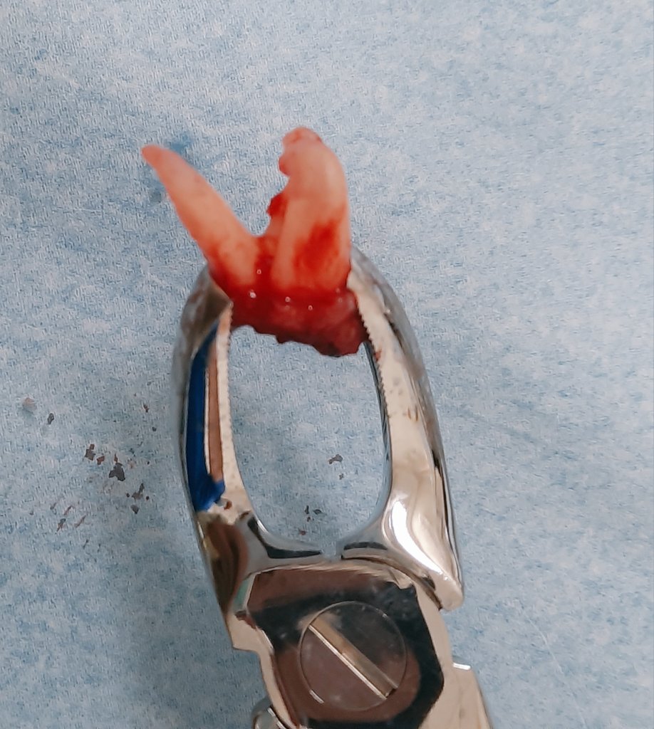 Interested case in #OMFS department.
  
Upper left first molar with severely curved divergent roots  

Note:  the direction of curvature in the X-ray almost 90° 😂
 
Fortunately Tooth had been extracted without any complications

Done ✔️
