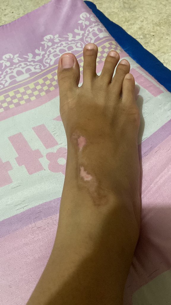 21_nauraa's tweet image. bersyukur bgt, lukanya udah sembuh, jujur aja salep dari @Hansaplast_id tu manjur bgt, soalnya temen ku bareng ku kecelakaan jg luka, sampe skrg blm kering krn cuma di biar in doang lukanya, ga di rawat. Dari hari pertama 2 produk ini yg aku pake, kl sekarang cuma salepnya aja