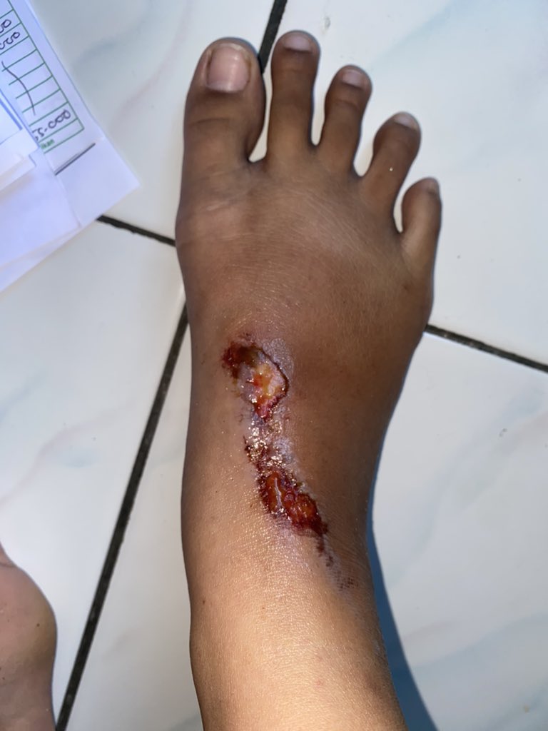 21_nauraa's tweet image. bersyukur bgt, lukanya udah sembuh, jujur aja salep dari @Hansaplast_id tu manjur bgt, soalnya temen ku bareng ku kecelakaan jg luka, sampe skrg blm kering krn cuma di biar in doang lukanya, ga di rawat. Dari hari pertama 2 produk ini yg aku pake, kl sekarang cuma salepnya aja