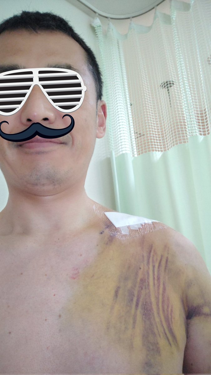 5/14
ダウンヒル最中のスリップ転倒により左肩鎖骨遠位端骨折、左肩甲骨骨折、左腰、右膝打撲、裂傷・擦過傷多数。
反省は雨がぱらついていた中で車と同じ速度で走るべきでなかったこと。目の前に車がいたので、悪くすれば命を落としていた。
サイクリング好きの皆様、お互い安全には気を付けましょう