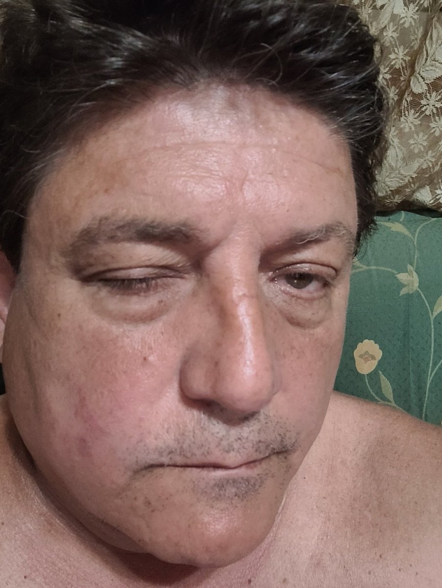 Francis59108531's tweet photo. 😡 Ayer en Tenerife fui brutalmente agredido al grito de GORA ETA, por 20 miembros del Frente Blanquiazul, ultras del Club Deportivo Tenerife

🙏 Compartirlo por favor

🇪🇸 Mi delito llevar pulseras de VOX y un llavero con regalos de guardias, un tricornio estaba en aquella barra https://t.co/gsNkvlZfld