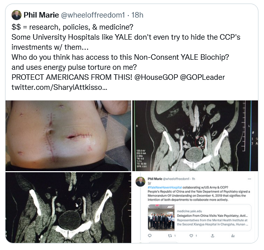 wheeloffreedom1's tweet photo. HOW MANY AMERICANS HAVE BEEN COVERTLY BIOCHIPPED BY UNIVERSITY HOSPITALS &amp; ARE TEST SUBJECTS?
#BiochipTerrorism
#HumanTorture
#MedicalResearch
#YaleUniversity
#WuTsaiInstitute
#Neuroscience 
#NeuralExperiments
#NeuralComputation
#YaleNewHavenHospital
#Nuremberg2 
#NurembergCode https://t.co/a2LfK4qhfi