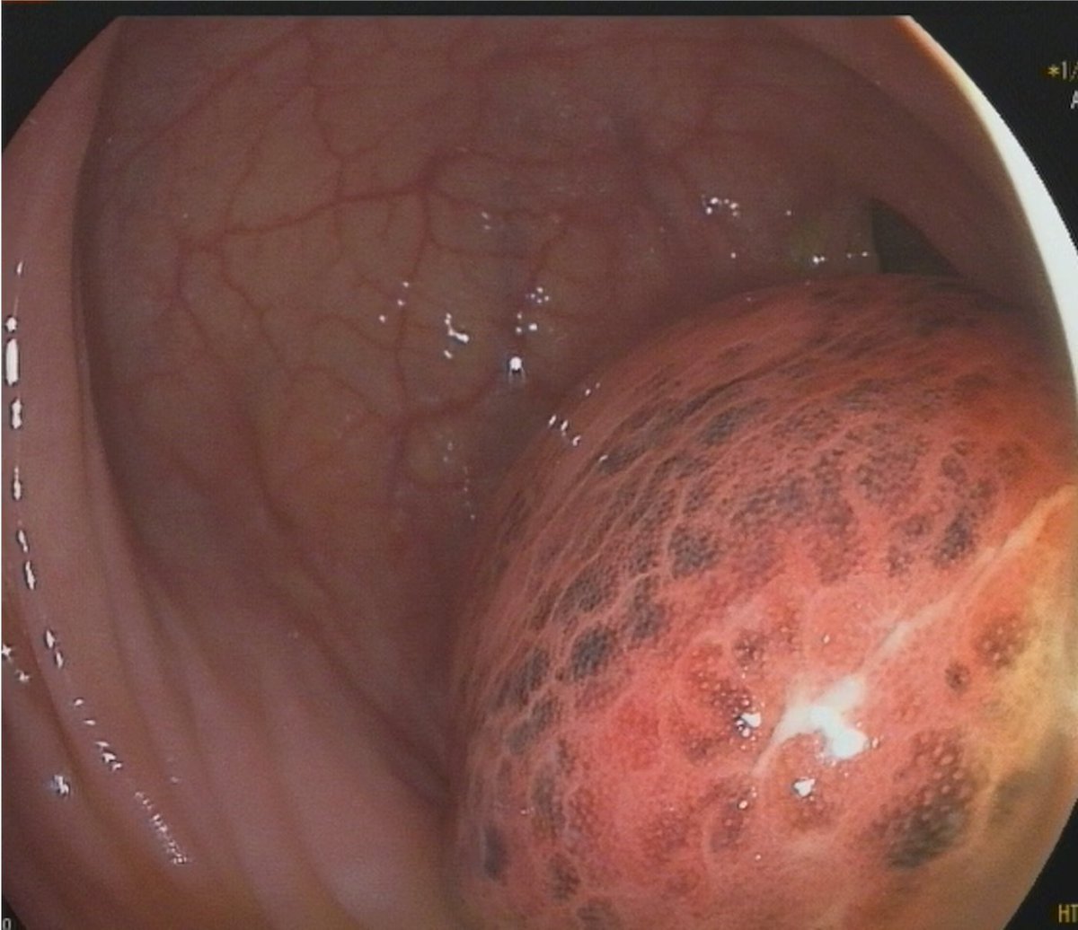 EndoCollab™ | GI Endoscopy Community tweet media