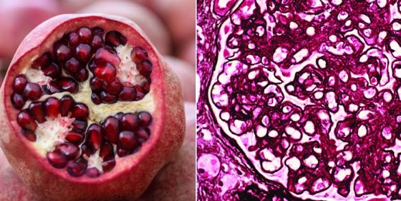 Tweetorial alert 📖📢 🚨

1/19
Hey #medtwitter

This entity is RARE but BEWARE❗️

We all like deposits in our banks, but deposits are certainly not appreciated in our glomeruli.

Even if they do look like a beautiful cross-section of pomegranate 👇