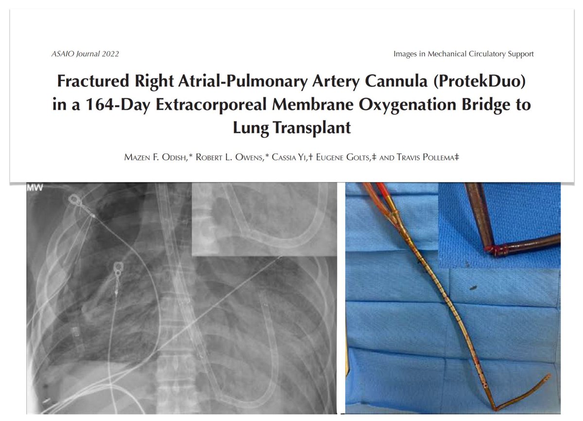 FOAMecmo's tweet image. 🫁 🫀RV failure &amp;amp; use of oxy-right ventricular assist device #RVAD. RV compliant, adaptive heart chamber,  not able to adapt to increase in afterload.
🐊 #ThePeoplesVentricle #SEECMO2023 @AkramMZaaqoq 

PS read on @asaiojournal experience with peripheral 2 cannula V-PA #ECMO vs