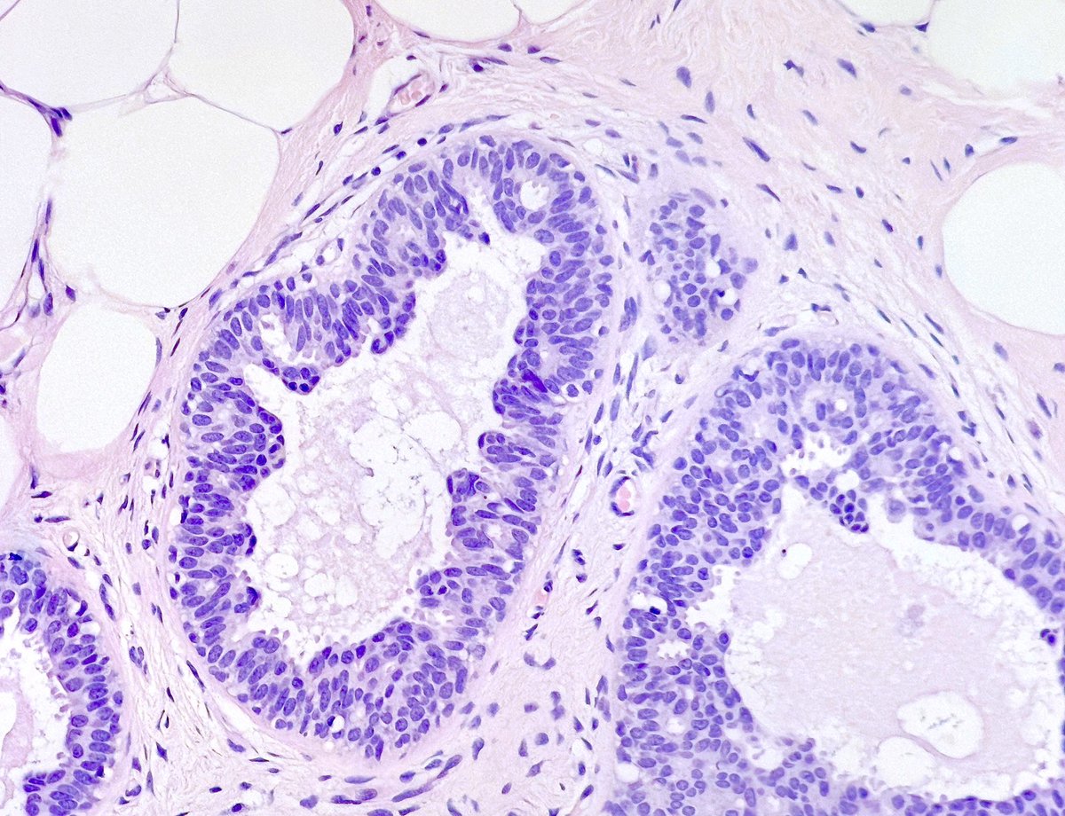 MBBS_Pathology's tweet photo. A tip for noobie breast pathologists π
Whenever you see #ColumnarCellChange πΈ1 or
#ColumnarCellHyperplasia πΈ2
Always keep your π open to detect co-existing #LobularNeoplasia πΈ 3
These often hang out together!
#PathTwitter
#pathology ππ https://t.co/W4pdJN2NXZ