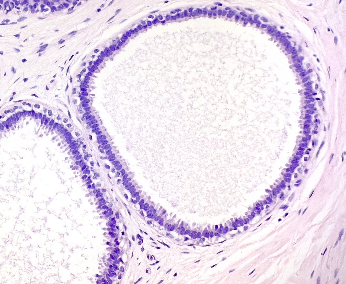 MBBS_Pathology's tweet photo. A tip for noobie breast pathologists π
Whenever you see #ColumnarCellChange πΈ1 or
#ColumnarCellHyperplasia πΈ2
Always keep your π open to detect co-existing #LobularNeoplasia πΈ 3
These often hang out together!
#PathTwitter
#pathology ππ https://t.co/W4pdJN2NXZ