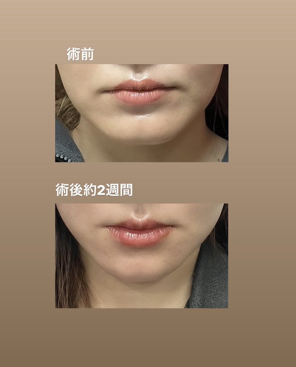 まだまだオトガイ腫れてるし笑うと猪木現象起きるけど、なんか、四角顎が改善されてる気がする、、、😭❤️❤️