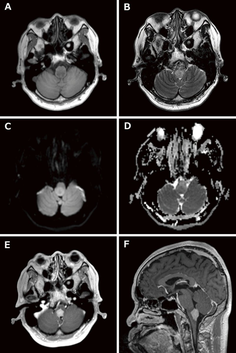 'New Arrival: Biopsy-proven Primary CNS Lymphoma in the Medulla Oblongata Presenting as Anorexia
doi.org/10.2176/jns-nm…
#MalignantBrainTumor #PrimaryCentralNervousSystemLymphoma #MedullaOblongata #Anorexia #NucleusTractusSolitarius #OpenBiopsy'