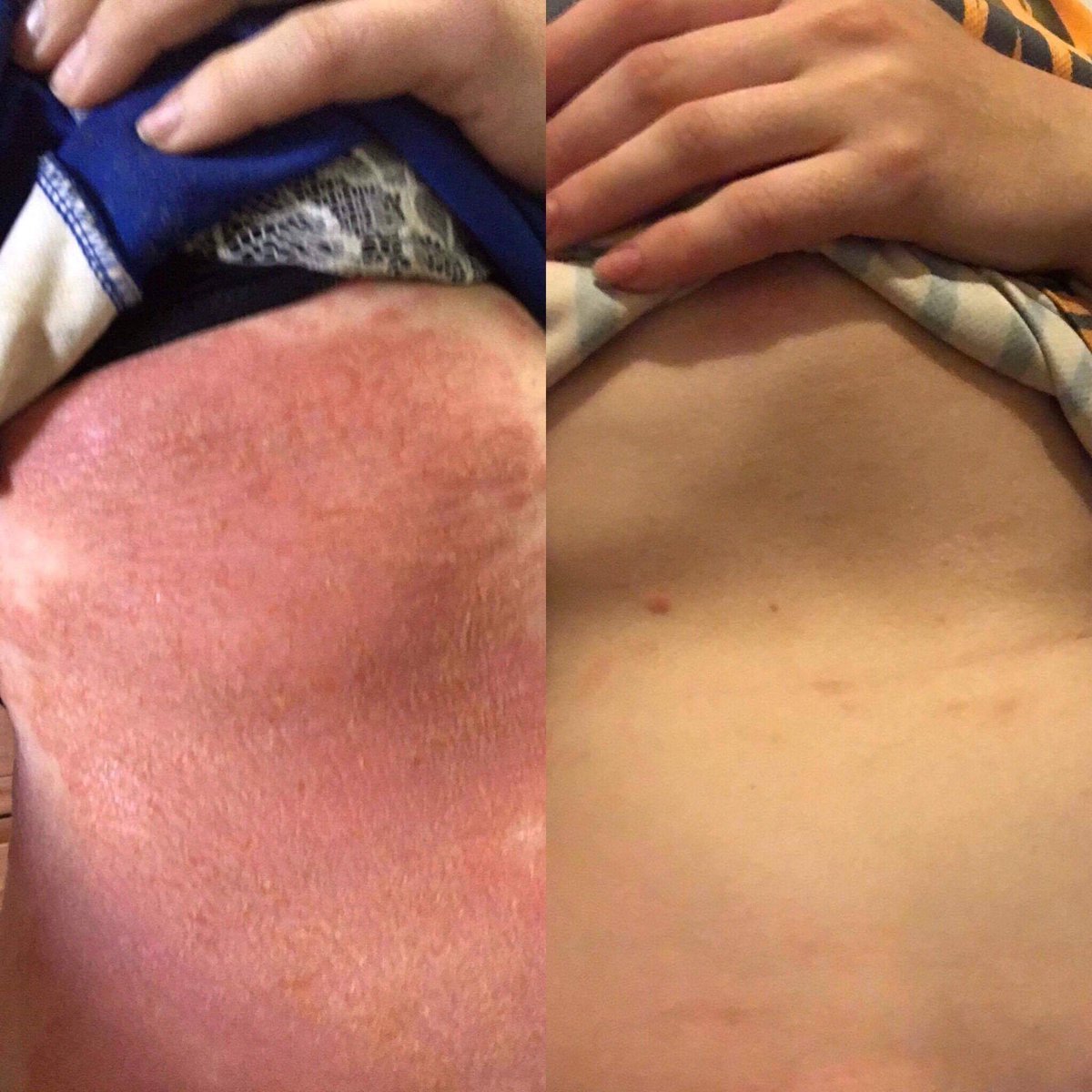 📷 Rethinking the Influence: Skin Science, Ingredients, and the Era of Unqualified Voices 📷
Cosmetic Chemistry is a Science. 📷

Check out this story - bit.ly/3IxPhZT
#eczema #dryskin #skincaretips #skincare #healthyskin #beautycare #glowingskin #health  #beautytips