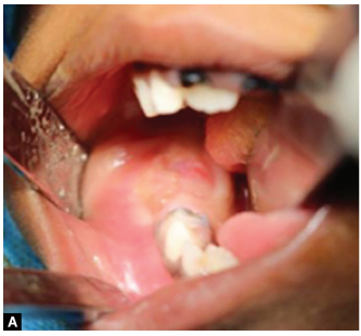 JaypeeJournals's tweet photo. Complex–compound Odontome with 526 Denticles: A Unique Case Report https://t.co/9nou6xH9V7 #Complex #Compound #Denticles #Odontome #MadhulaxmiMarimuthu #NikhilMarwah #IJCPD #JaypeeJournals https://t.co/7bcMTX5oam