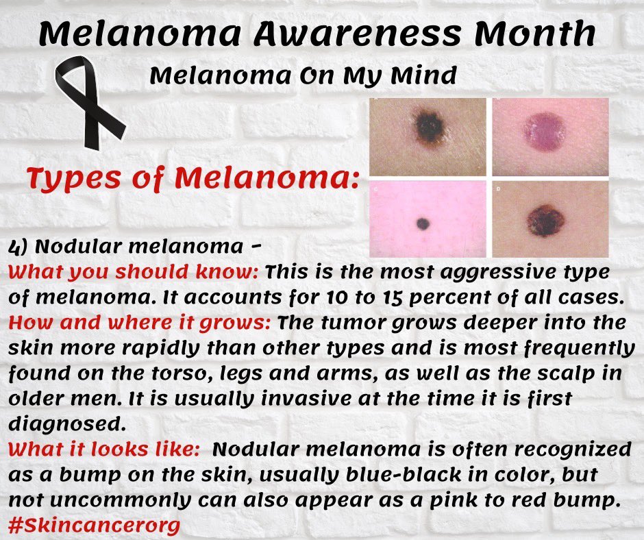 Melanomaonmymin's tweet photo. 🖤Melanoma Awareness Month🖤
4) Nodular melanoma
What you should know: This is the most aggressive type of melanoma. (Info in graphic)
#melanoma #cancer #awareness #skin #nodular #skincheck #prevention #skincare #skincancerfoundation #melanomaawarenessmonth #melanomaonmymind https://t.co/DaWpeDxXxV